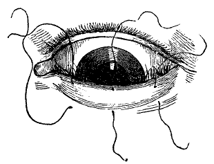 how to stitch the eye in entropium